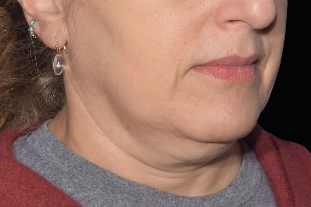 EMface facial toning Dublin - before photo of the jawline and neck Jawline and neck before EMface facial toning at our Dublin clinic